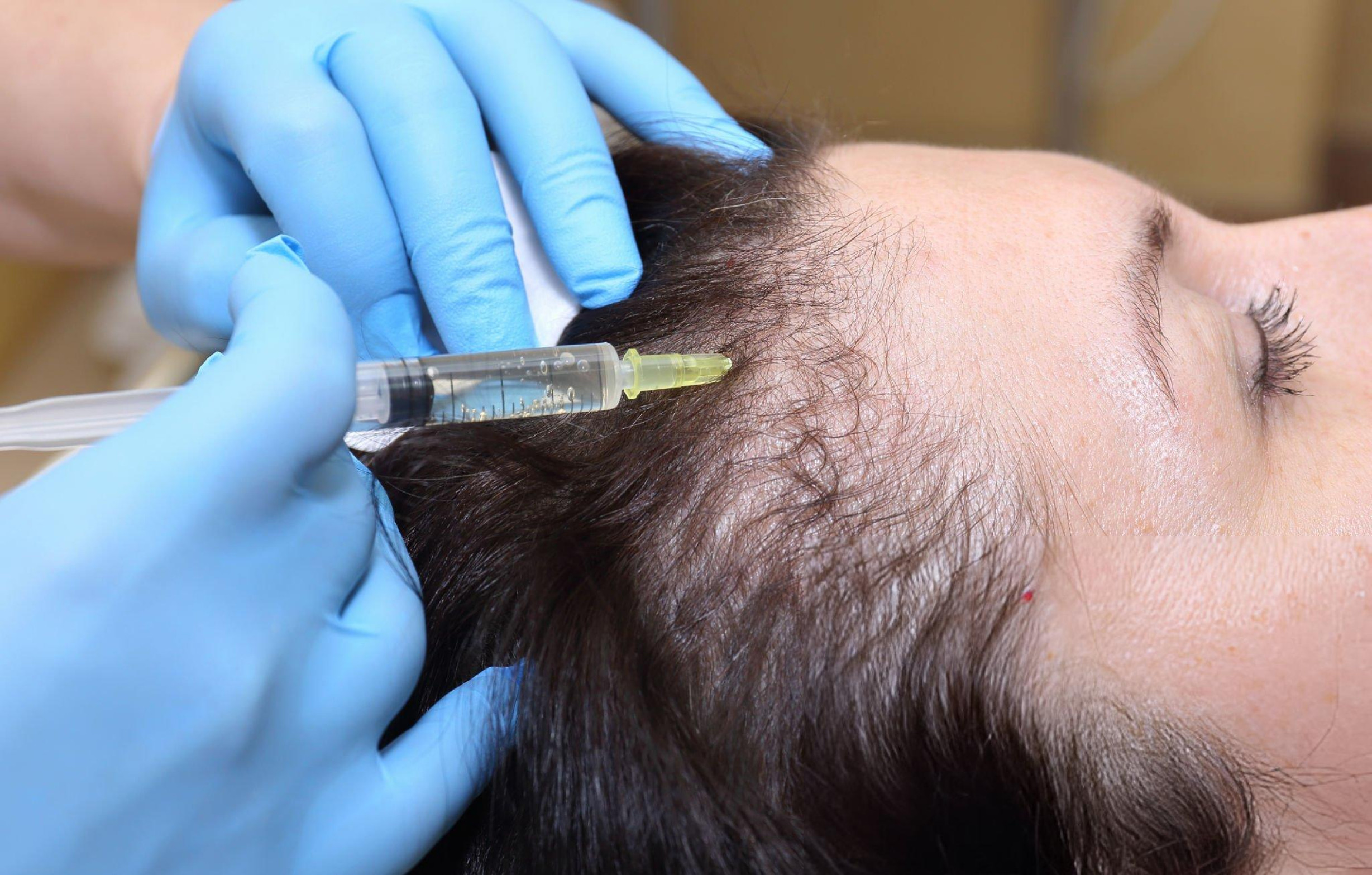 ExoSignal Hair treatment results